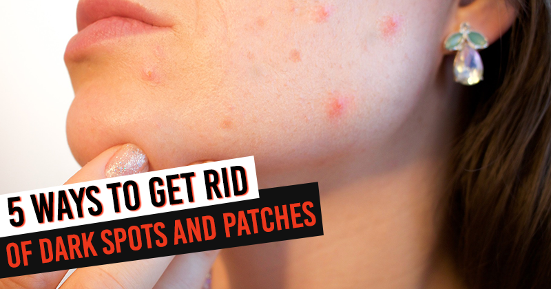 dark spots