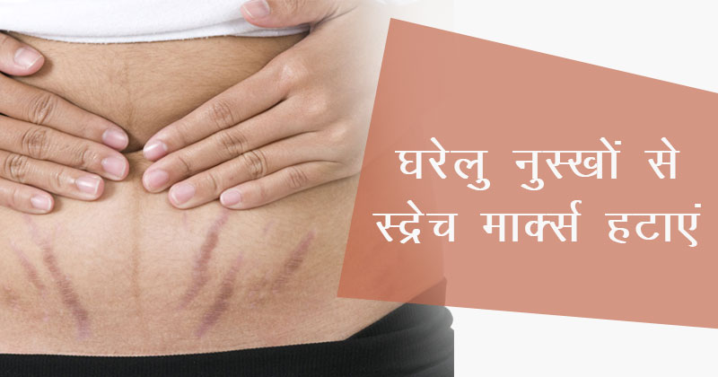 stretch marks hindi cover