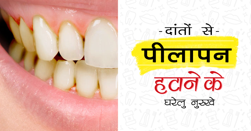 _432_दांतों से पीलापन
