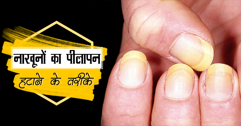 _548_नाखूनों का पीलापन