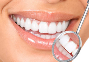 teeth whitening is a popular option